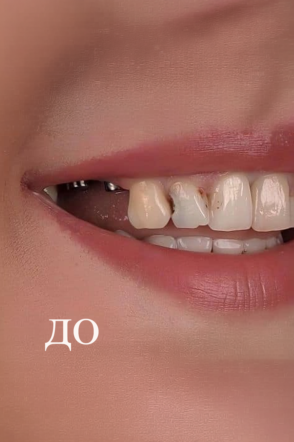 До — два імпланти