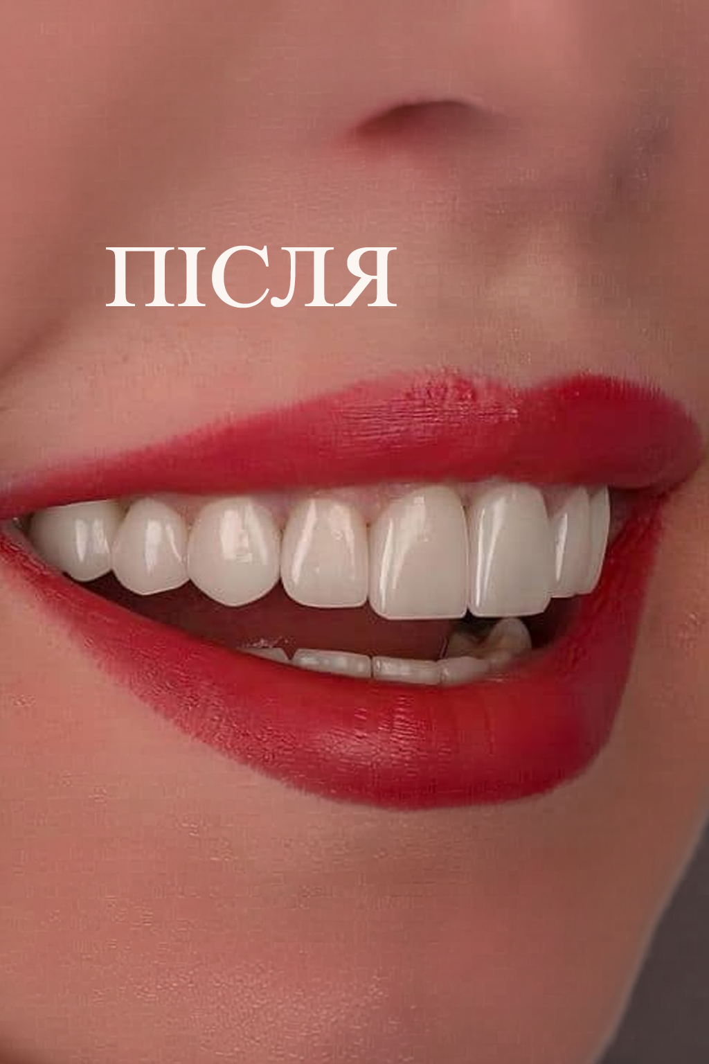 Після — два імпланти